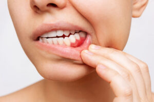 Gum Disease Treatment In Tampa And Trinity: Early Signs, Scaling And Root Planing, And Long Term Protection