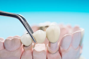 Dental Bridges In Tampa And Trinity: A Reliable Way To Replace Missing Teeth