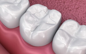 Tooth Colored Fillings In Tampa And Trinity: Natural Looking Repairs For Cavities And Small Chips