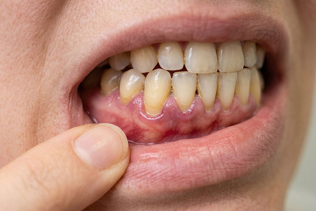 Gum Recession Treatment In Tampa And Trinity: Why Gums Recede And What You Can Do